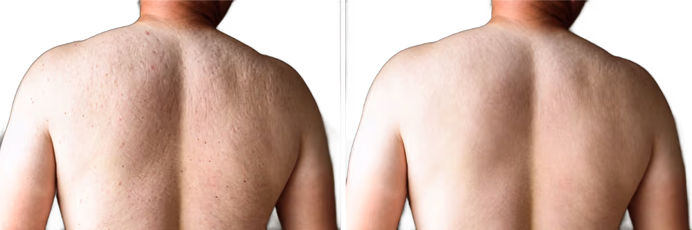 BioRePeel 50 TCA body treatment results