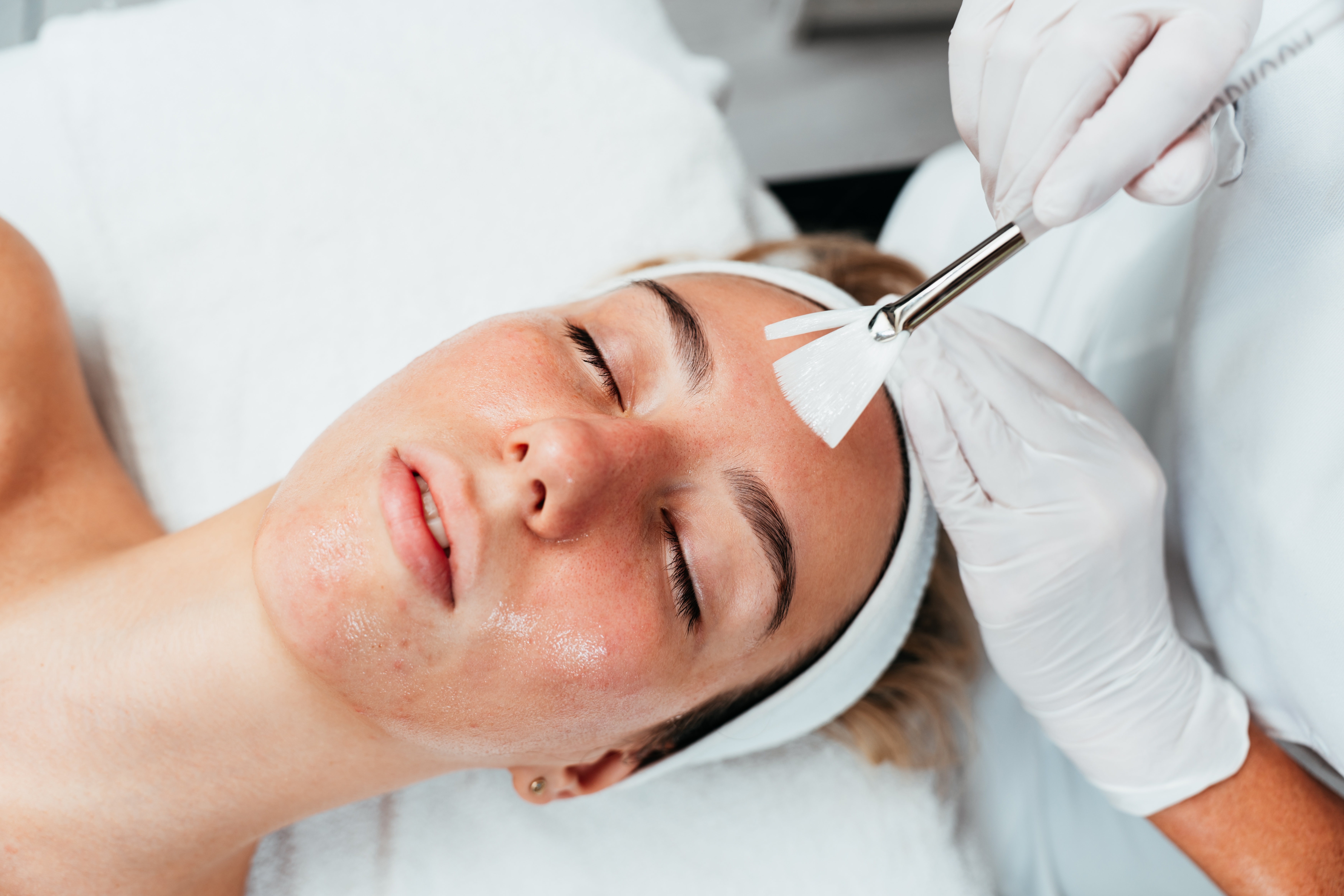 Glycolic acid peel benefits