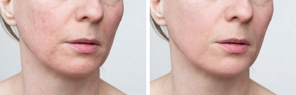 Glycolic Acid Peel Results - Skin Texture - After
