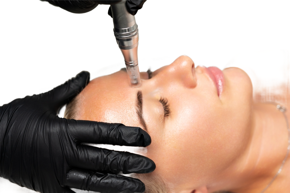 Microneedling