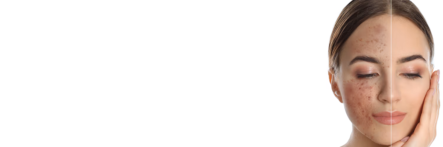 TCA Chemical Peel Treatment