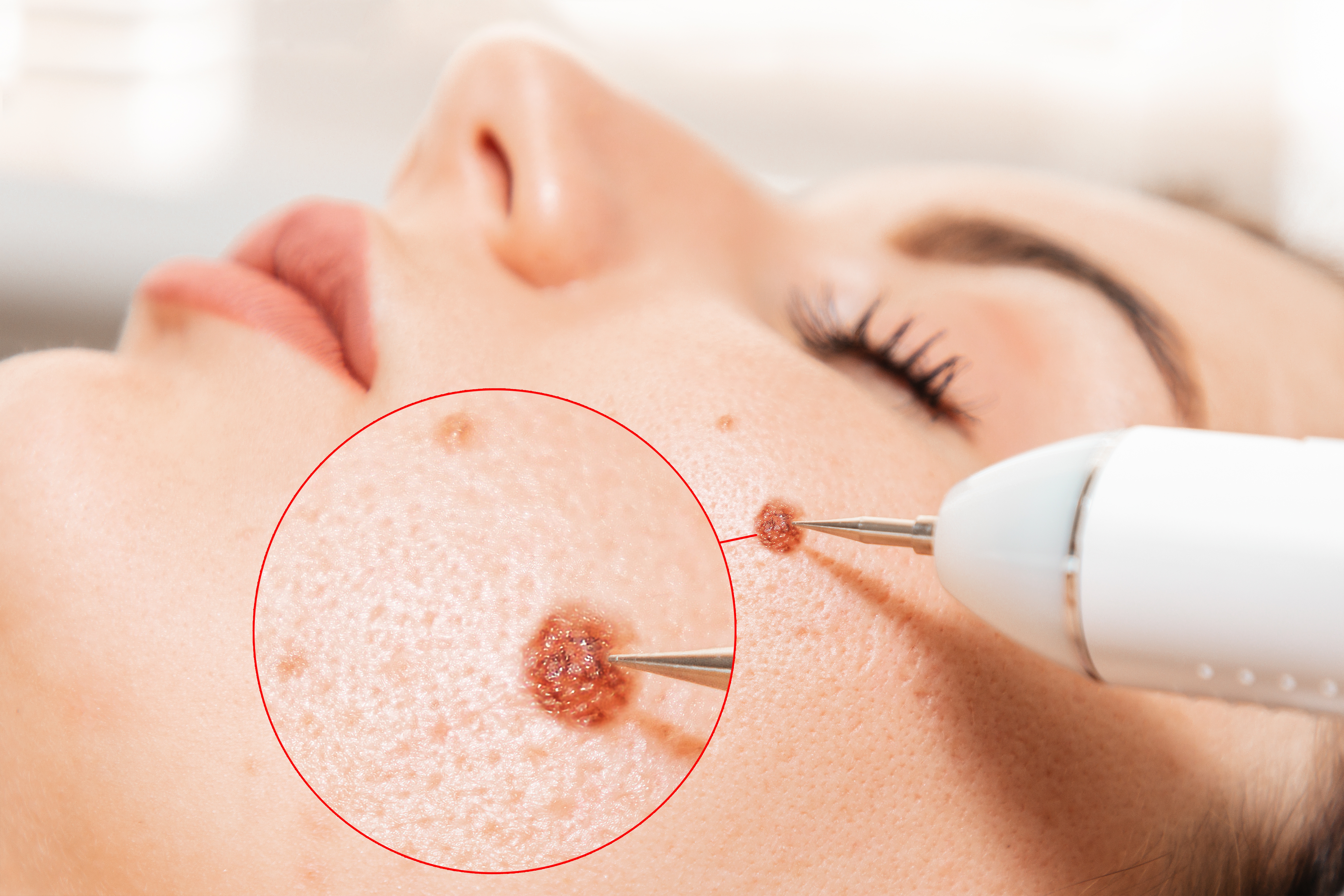 Precise plasma mole removal process