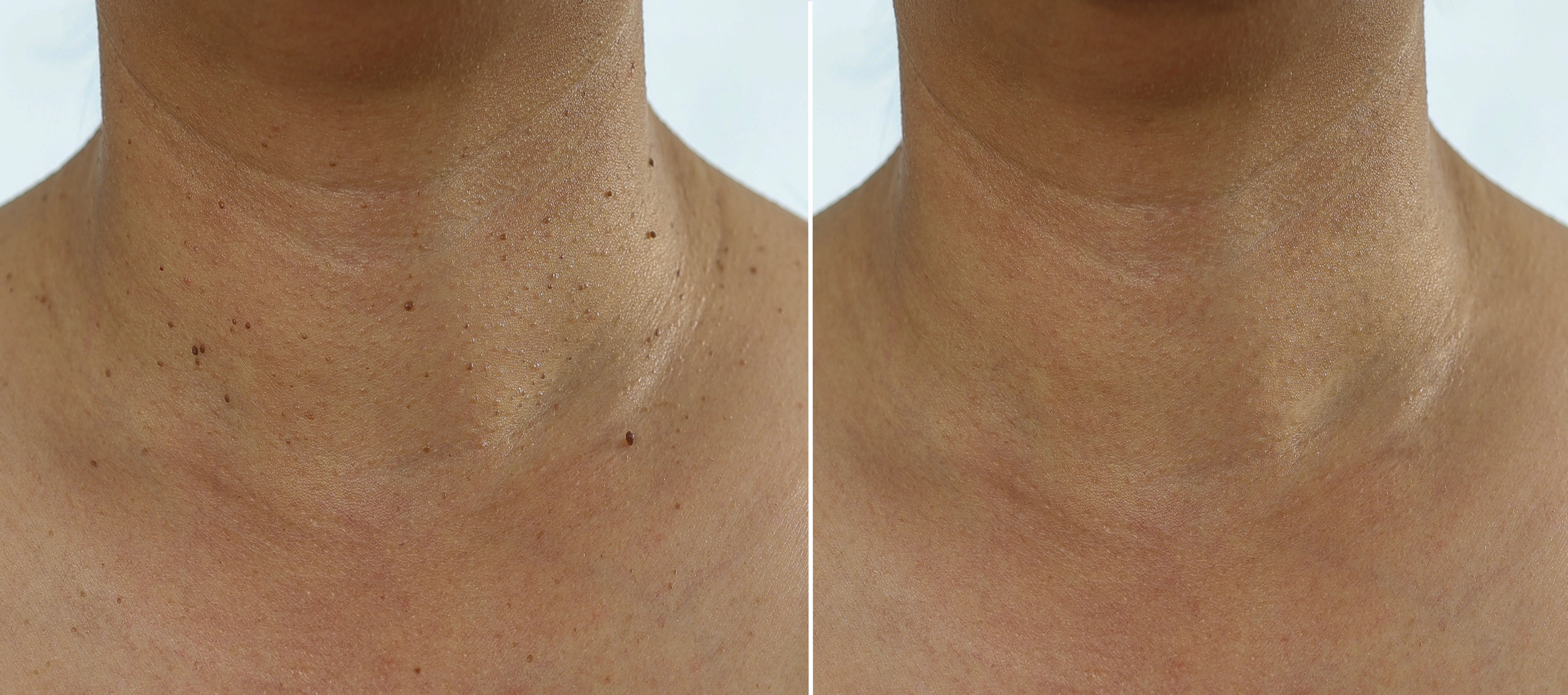 Plasma skin tag treatment process