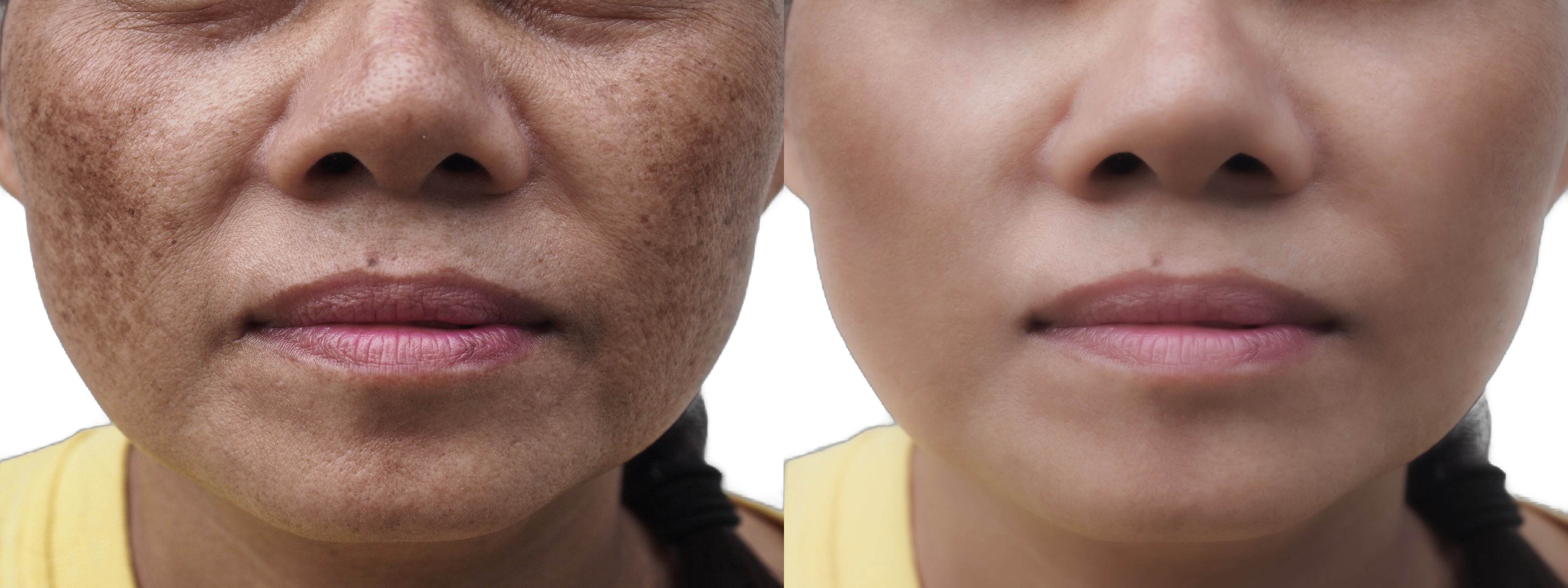 Precise pigmentation treatment process